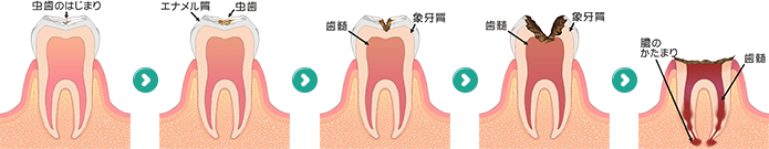う歯（虫歯）